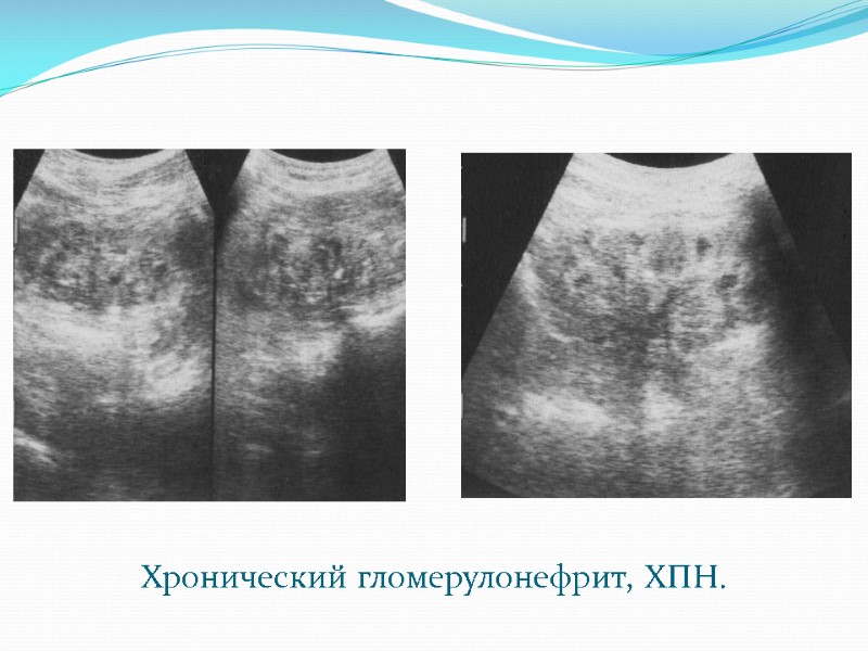 Хронический гломерулонефрит, ХПН.